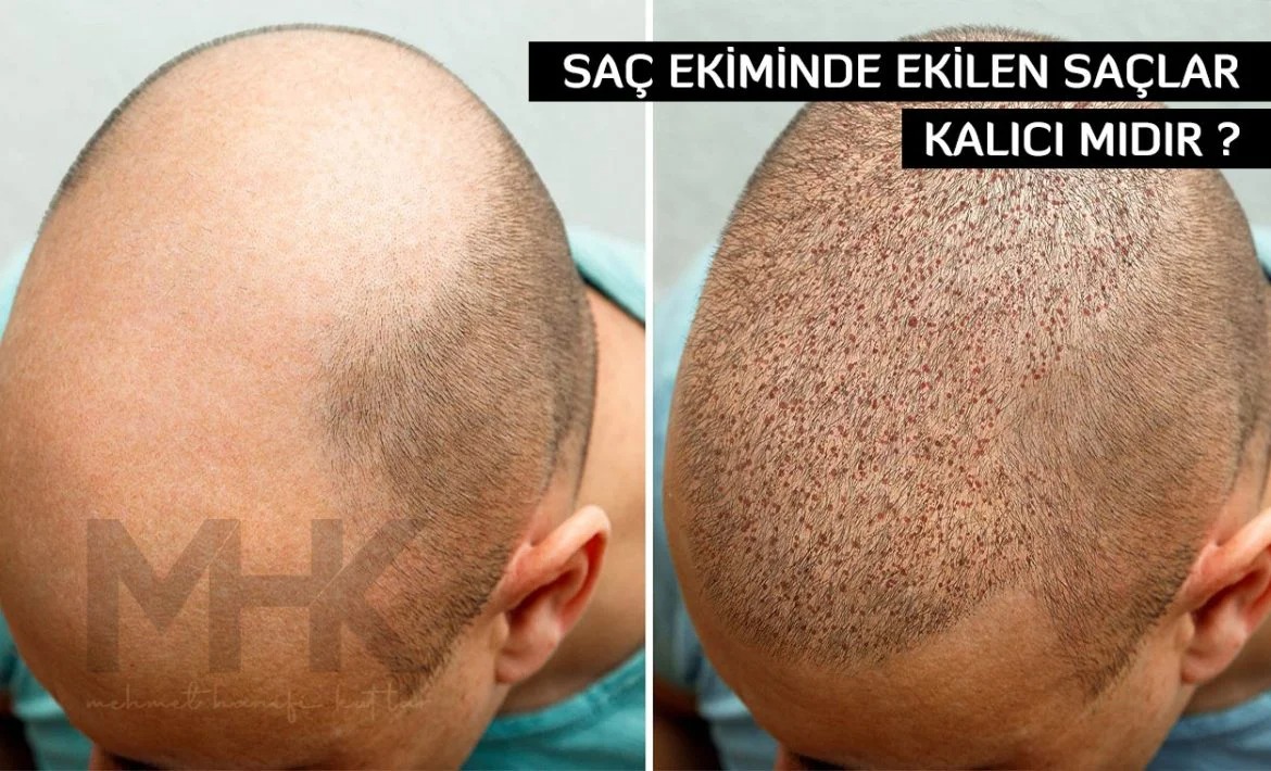Saç Ekimi İşlemi Nedir, Nasıl Yapılıyor?
